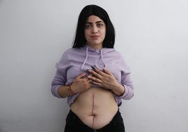 María, con peluca para tapar las heridas, muestra la cicatriz que recorre su abdomen.